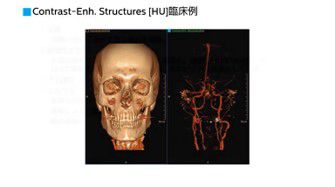 その３： Contrast-Enh. Structures、Uric Acid、Uric Acid Removedについて
