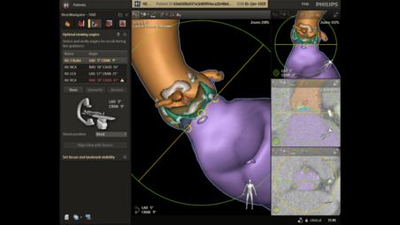 Automatic view planning aids positioning