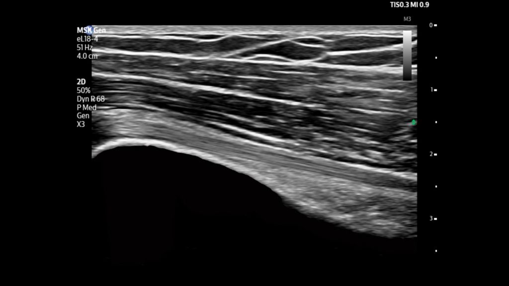  Bicep tendon shown using eL18-4 transducer on Flash 5100 POC.