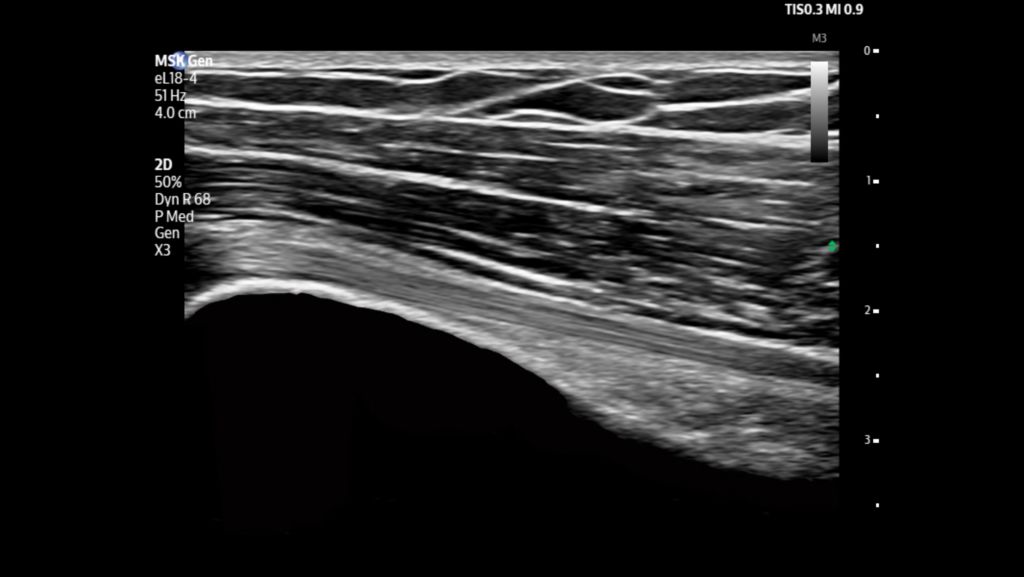 Bicep tendon shown using eL18-4 transducer.
