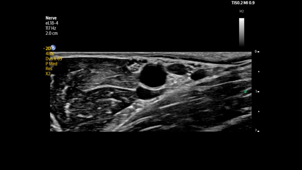 Axillary nerves and vessels shown using eL18-4 transducer.