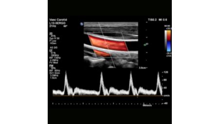 Il s'ajuste automatiquement pour obtenir une sensibilité et une résolution optimales du flux, réduisant de 10 à 3 le nombre d'étapes et diminuant de 68 % en moyenne le nombre de pressions répétitives sur les boutons.