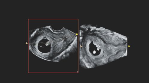 3D9-3v early OB with FlexVue