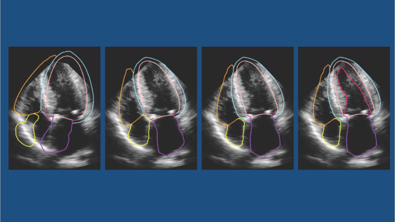 Philips HeartModel