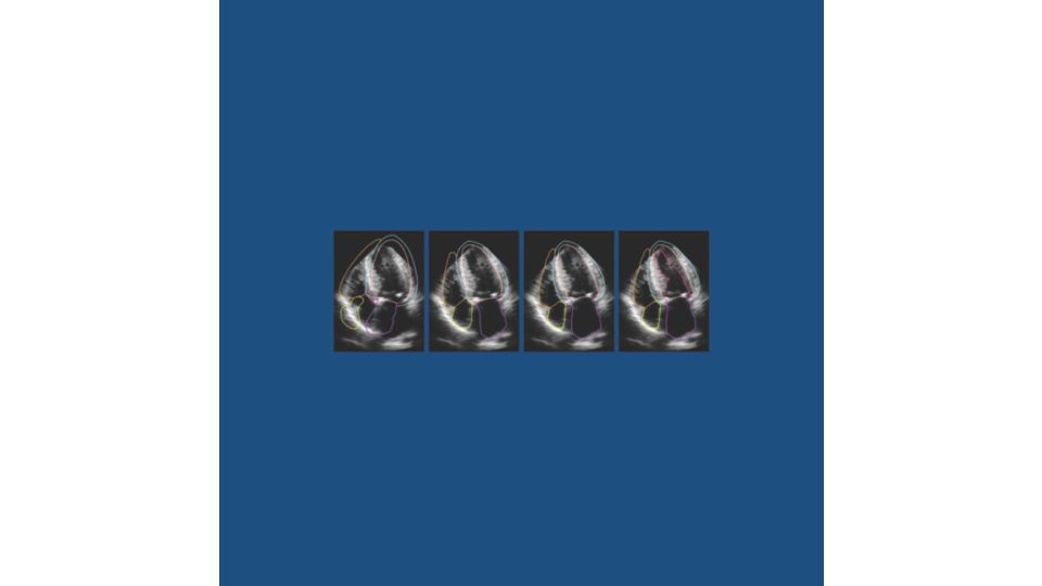 Philips HeartModel