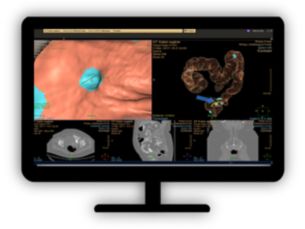CT Virtual Colonoscopy Veralook CAD​ Automatically detect potential polyps in CT colonography exams 