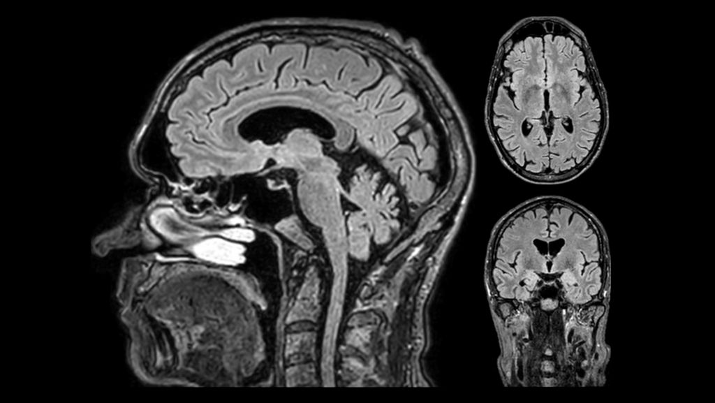 cs6.5 Flair BrainView
