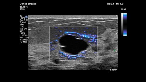 Breast cyst with MFI and eL18-4 transducer dense breast preset