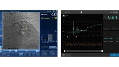 Comparison of Philips iFR measurement software interfaces
