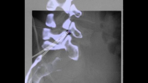 Lung Microwave Pre-treatment XperCT with XperGuide plan.