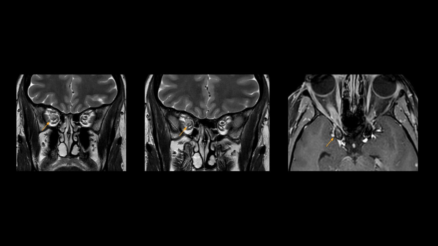 MRI of optic nerve sheath meningioma