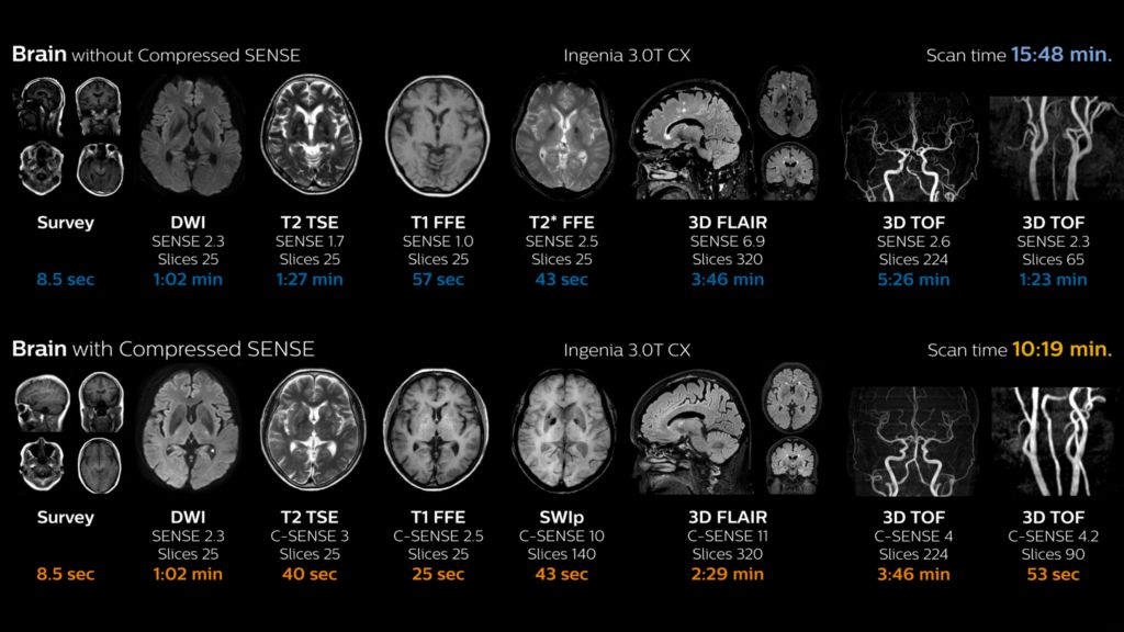 Comparing brain exams with and without Compressed SENSE