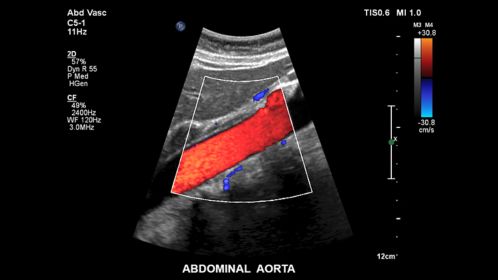 Abdominal aorta