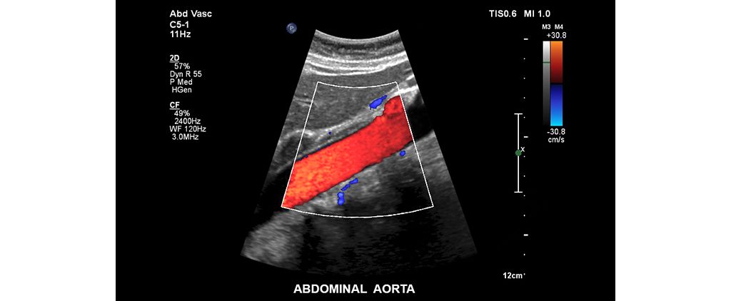 Abdominal aorta