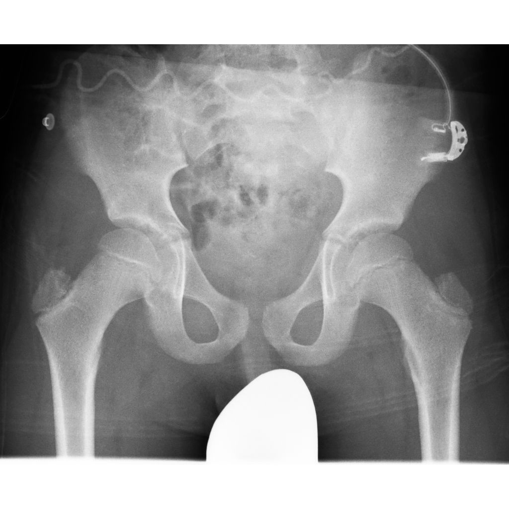 SkyFlow Plus - Grid-like contrast for free rad examinations