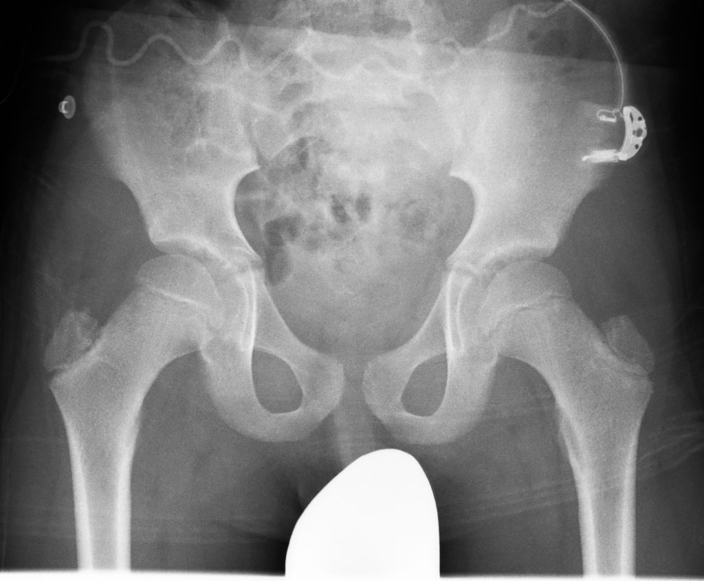 SkyFlow Plus - Grid-like contrast for free rad examinations