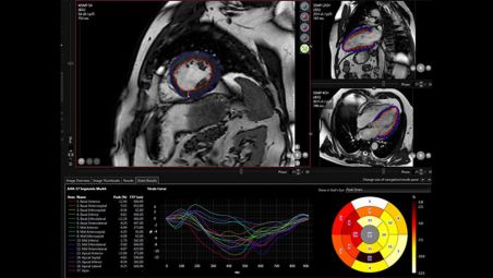 Quantify Myocardial Strain​