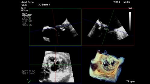 Live 3D TEE shown with X8-2t