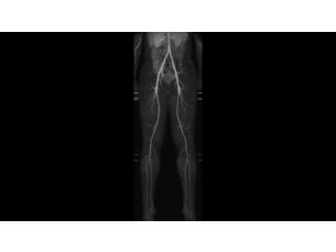 mDIXON XD MultiStation - Vascular MR clinical application