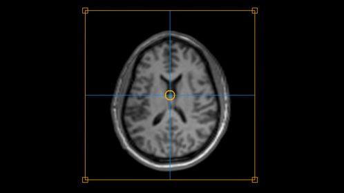 SmartExam Brain - Auto alignment of the imaging slices
