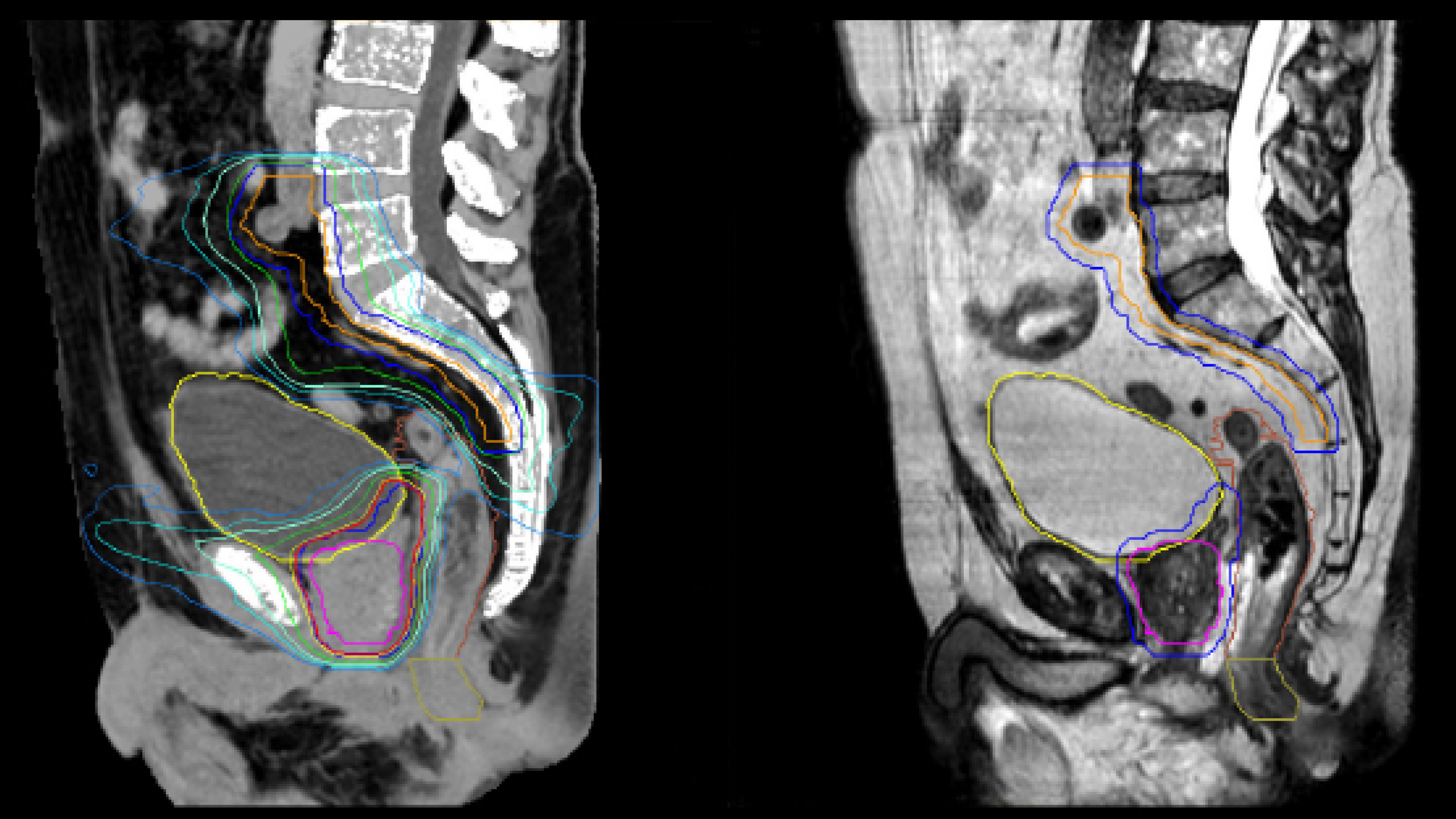 MRCAT for dose calculation and MRI used for delineation of prostate and organs at risk. 