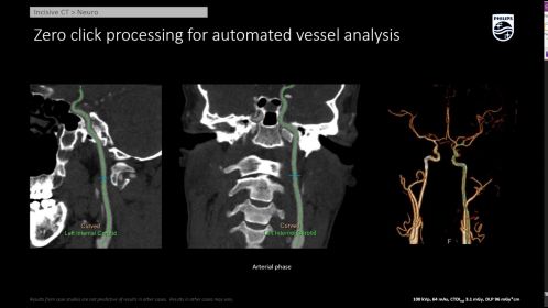 Incisive CT Neuro - CTA Head Neck