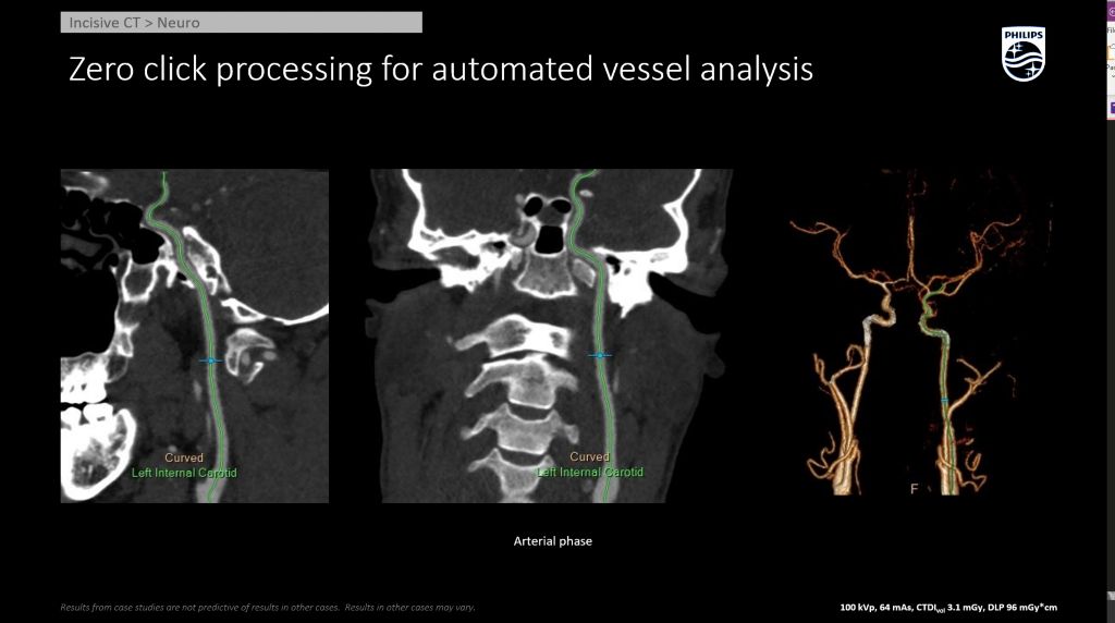 Incisive CT Neuro - CTA Head Neck