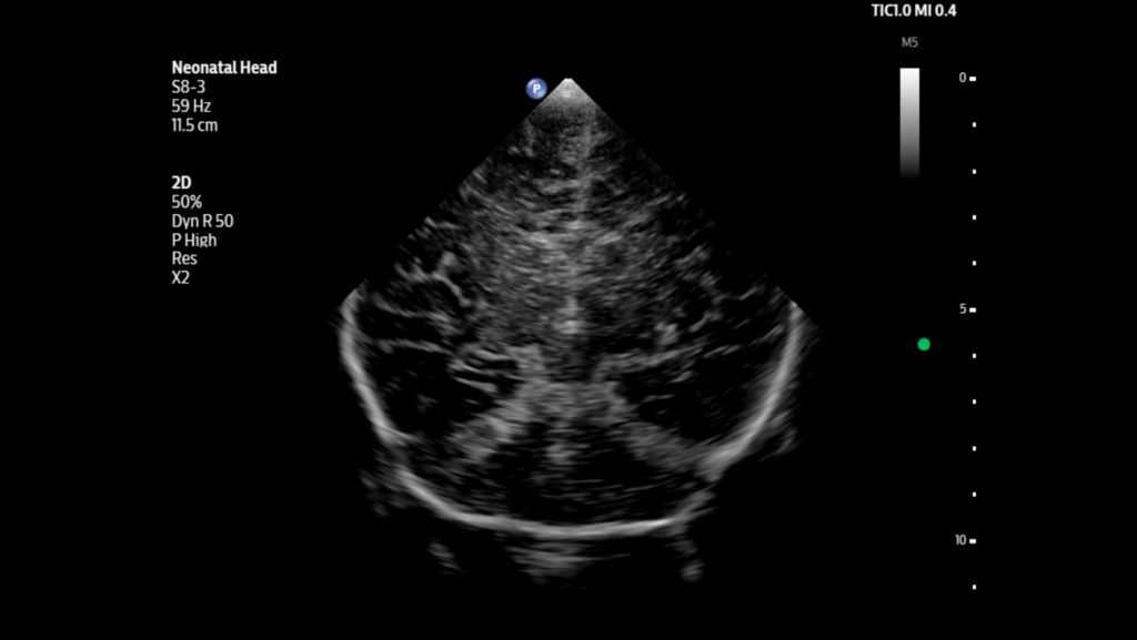 Neonatal head shown using S8-3 transducer.