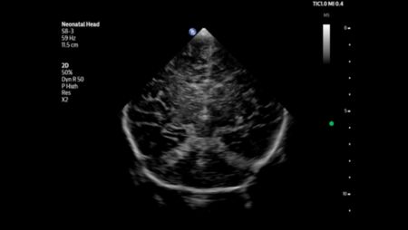 Neonatal head shown using S8-3 transducer.