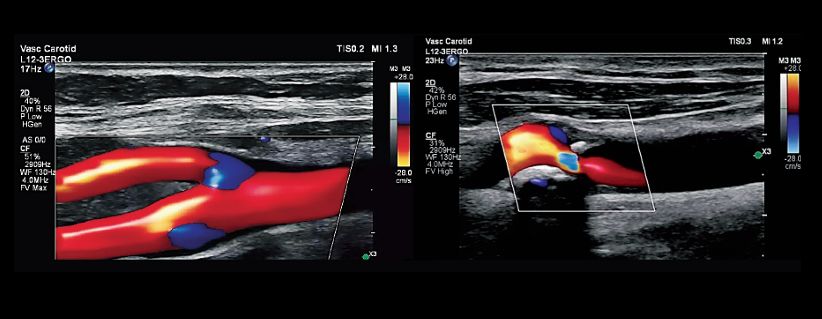 Two Color Doppler vascular carotid images illustrate the 3D-like visualization and excellent color containment with the vessel lumen offered by Flow Viewer. 