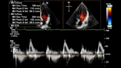 xPlane Doppler MV AutoMeasure clinical image