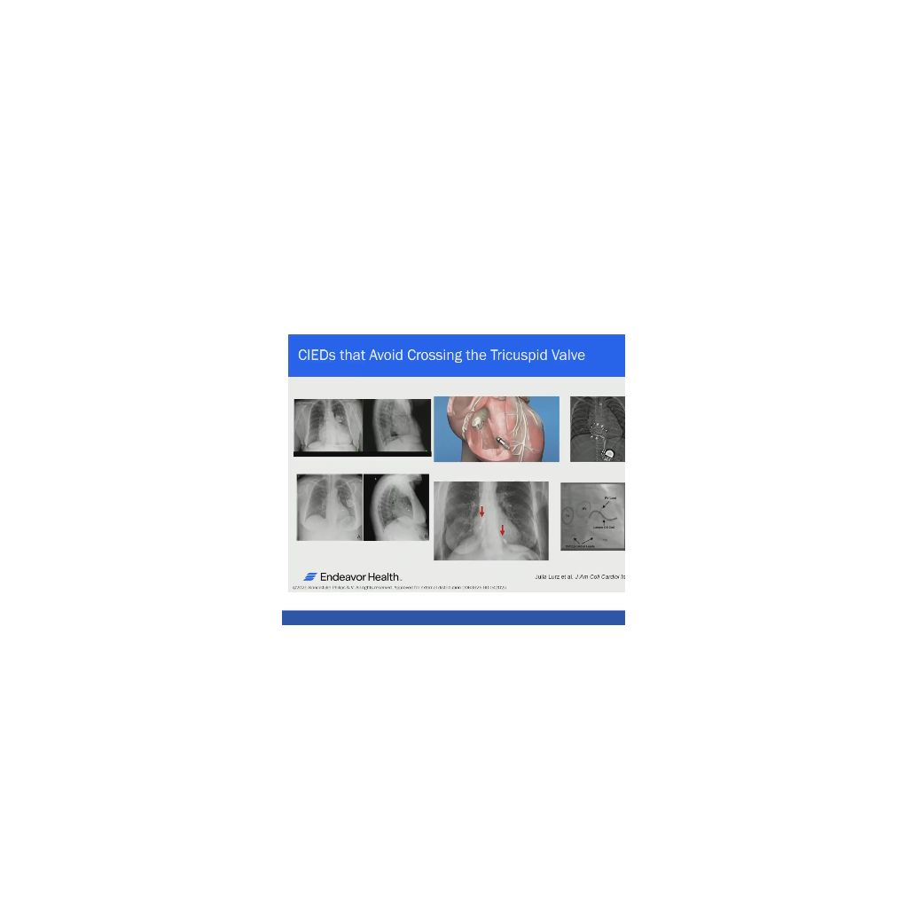 Heart Rhythm Theater Philips Lead Management Cases 
