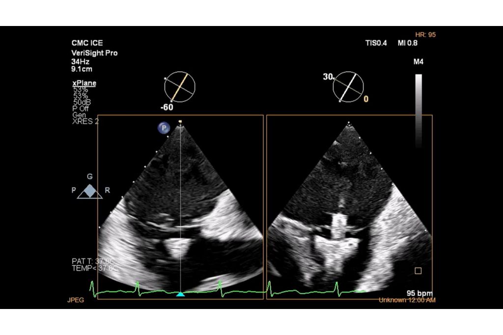 Assessing position and orientation of TriClip device below leaflets using xPlane