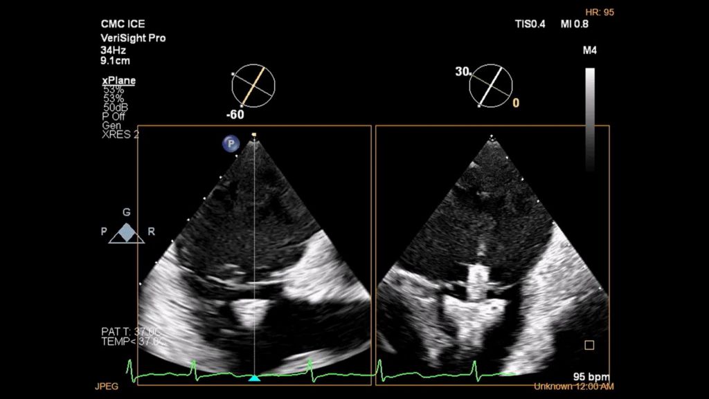 Assessing position and orientation of TriClip device below leaflets using xPlane