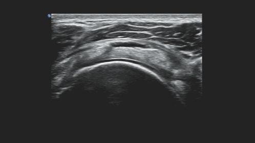 Shoulder rotator cuff
