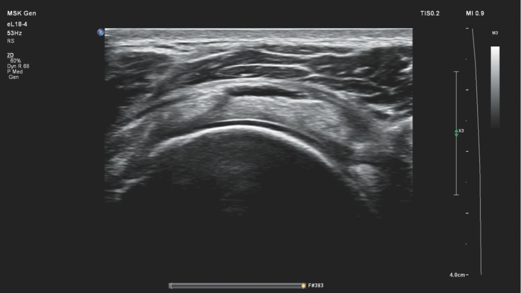 Shoulder rotator cuff image using eL18-4 transducer on Compact 5000 Series