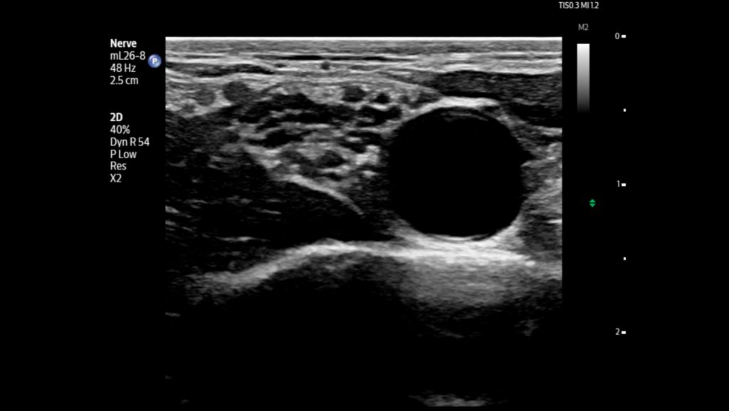 Supraclavicular nerve and artery shown using mL26-8 transducer.